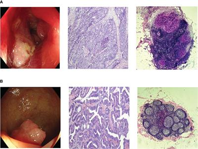 High serum mannose in colorectal cancer: a novel biomarker of lymph node metastasis and poor prognosis